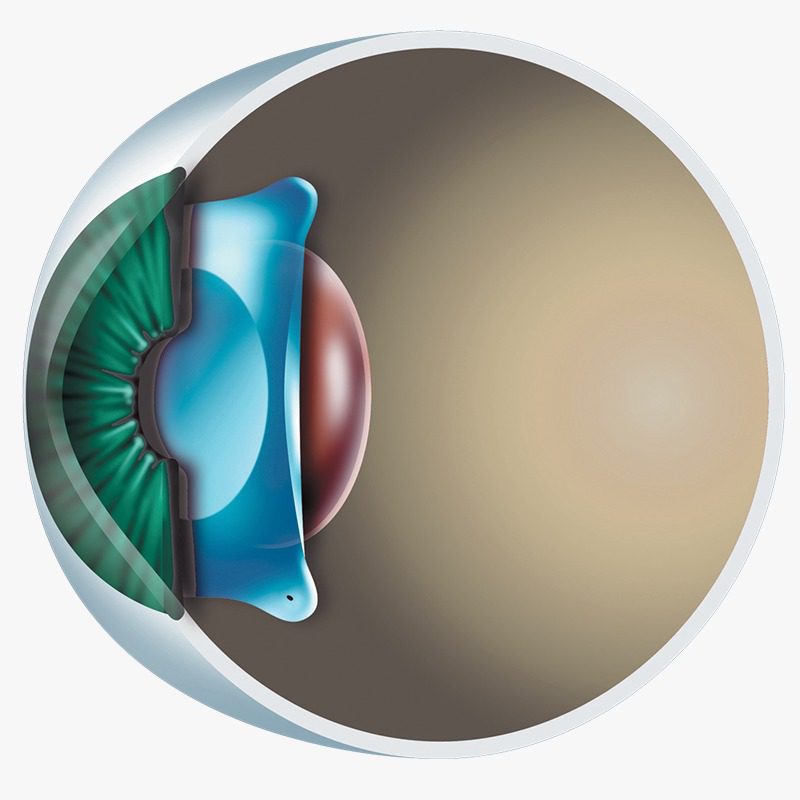 implante de lente facica