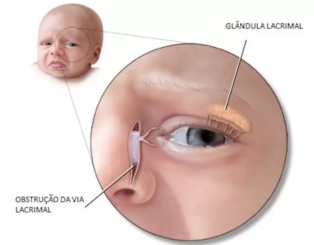 prisma visao obstrucao congenita do canal lacrimal 02