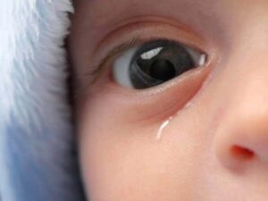 Leia mais sobre o artigo Obstrução Congênita do canal lacrimal, o que é?